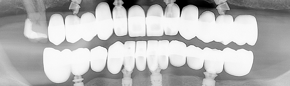 invisalign-pozuelo-de-alarcon-ortodoncia