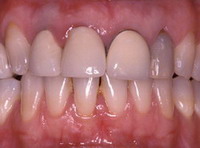 clinica-somosaguas-pozuelo-alarcon-corona-ceramica