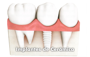 clinica-somosaguas-pozuelo-alarcon-tratamiento-ceramica