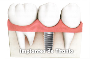 clinica-somosaguas-pozuelo-alarcon-tratamiento-titanio