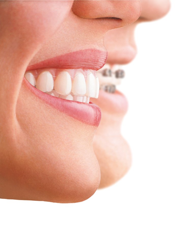 invisalign-pozuelo-de-alarcon-ortodoncia