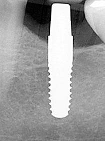 Implantes cerámica-1.jpg