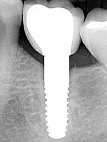 Implantes cerámica-2.jpg