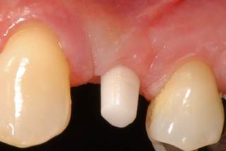 Implantes cerámica-1-2.jpg