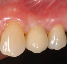 Implantes cerámica-2-2.jpg